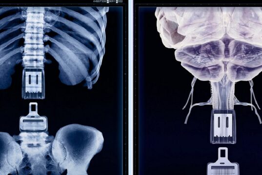 Dr. Avelino Parajón: esperanza ante la lesión medular a través de la cirugía mínimamente invasiva de columna